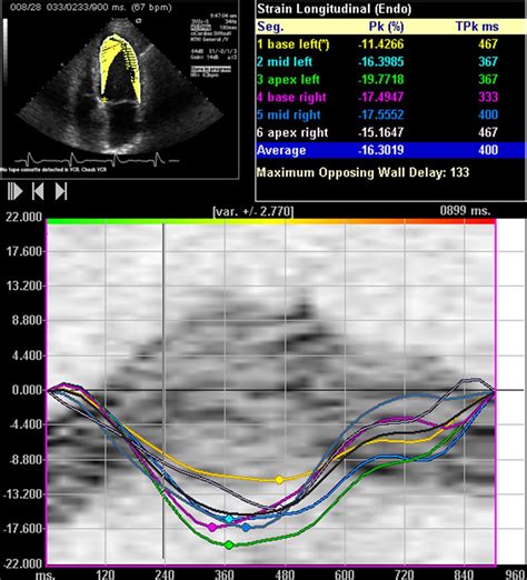 lv og strain|lv strain echo normal values.